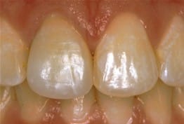 Porcelain Crowns