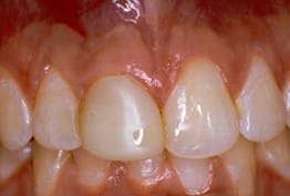 Porcelain Crowns